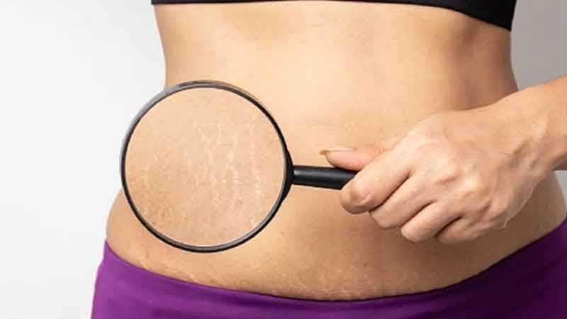 New trend: Brazilian women get tattooed to hide dark circles and cover stretch marks