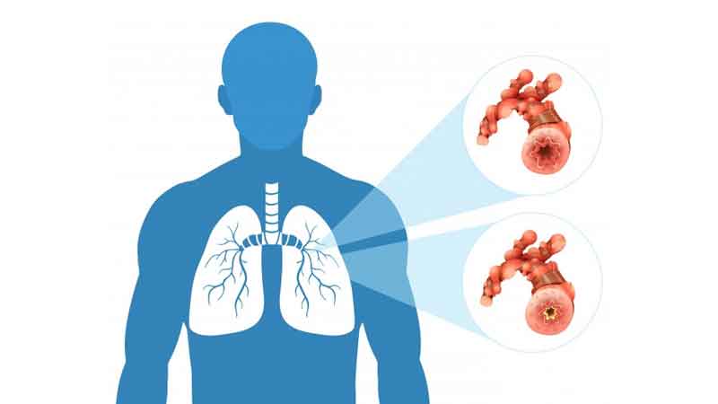How to keep lungs healthy in this second wave of corona know its remedies