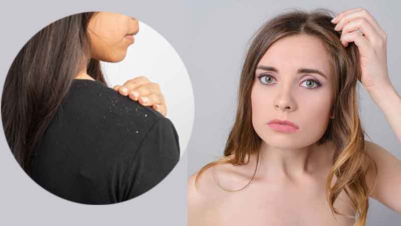 If your dandruff is not going away with shampoo and serum, then definitely follow these 3 home remedies for dandruff