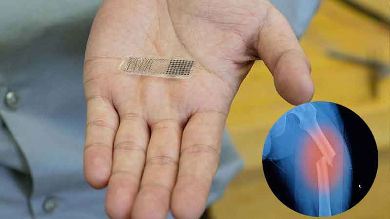 Electric implant will dissolve in the body by connecting broken bones